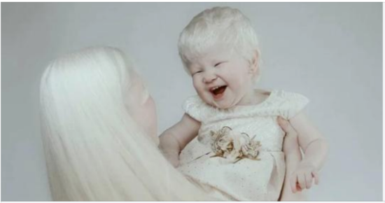 Albino Sisters Born 12 Years Apart Amaze Whole World With Their Extraordinary Beauty