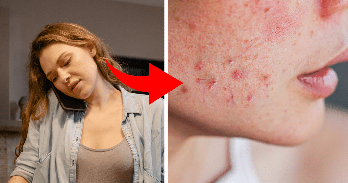 8 Body Parts Acnes Can Appear And What Triggers Them