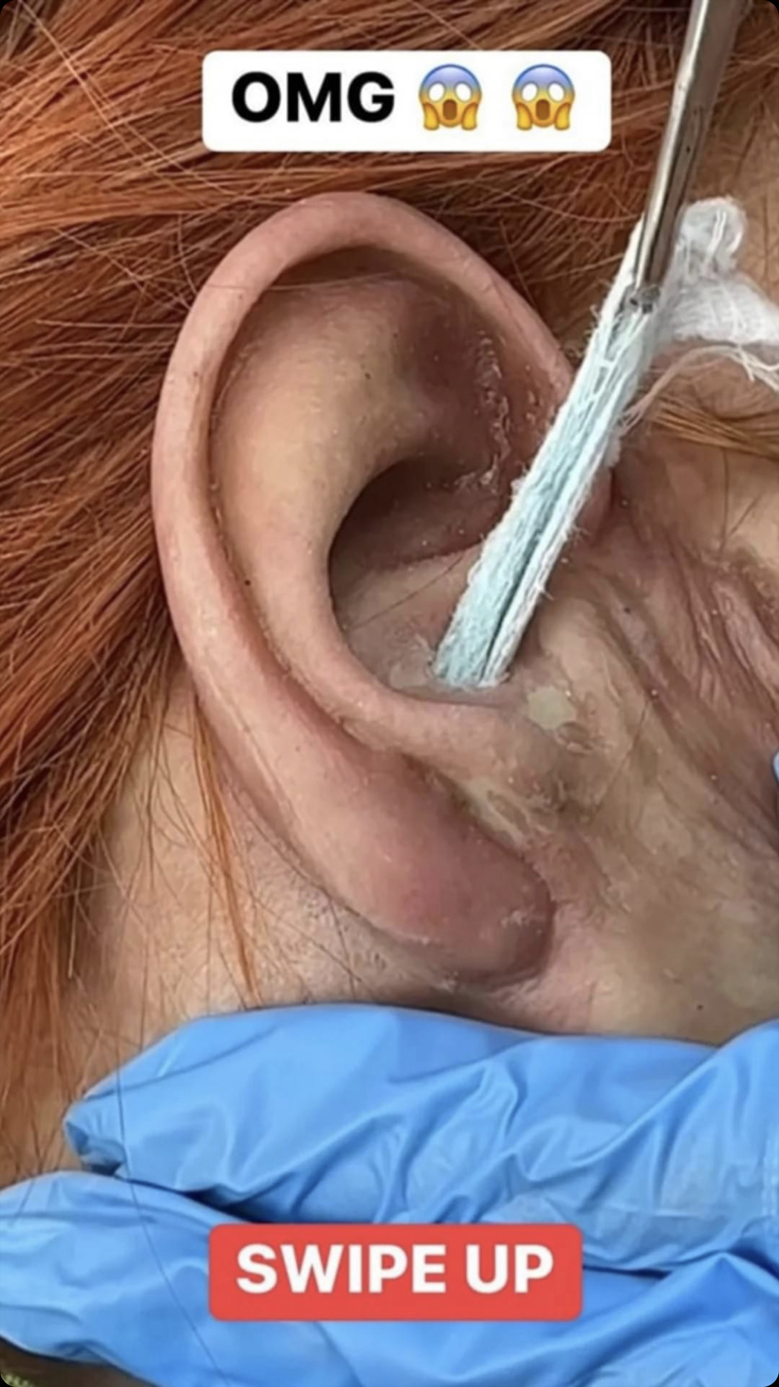 Weird substance removed from ear
