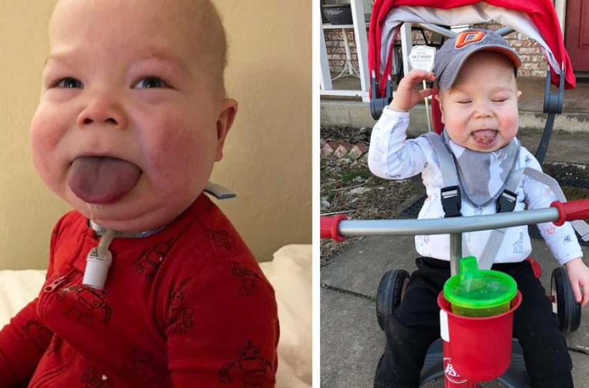 This kid was born with a tongue too big: how he looks like now