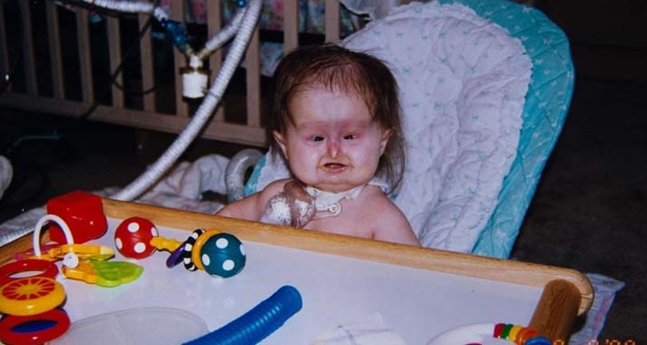 Baby Born With Unusual Syndrome – 22 Years Later She Looks Amazing