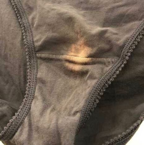 If you find a “bleach” patch on your underwear, here’s what it means