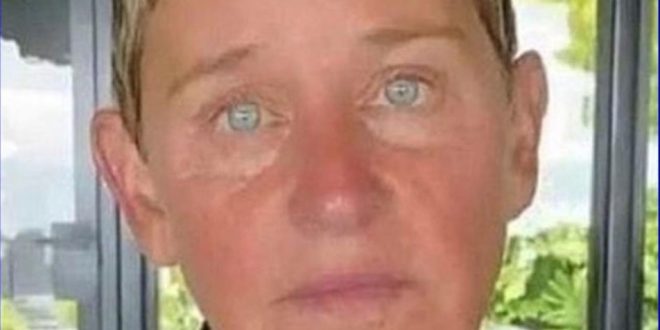 Ellen DeGeneres expressed, “It’s incredibly painful. I had no idea that was a symptom.”