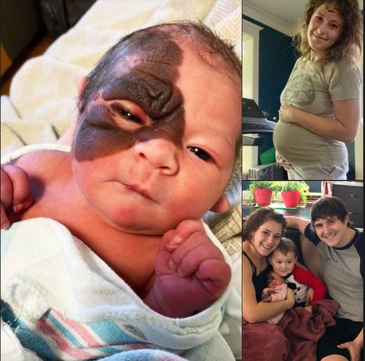 Mom on a mission to show daughter with extremely rare birthmark that she is beautiful